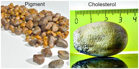 Passing A Gallstone How Does It Feel Gallstones Picture Causes Age