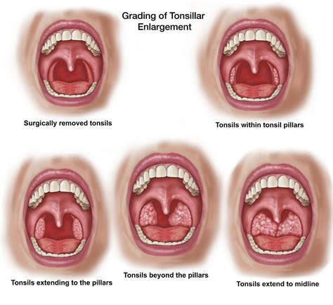 Tonsil Cancer Stages