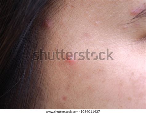 Dermatological Disease Acne Acne On Face Stock Photo 1084011437