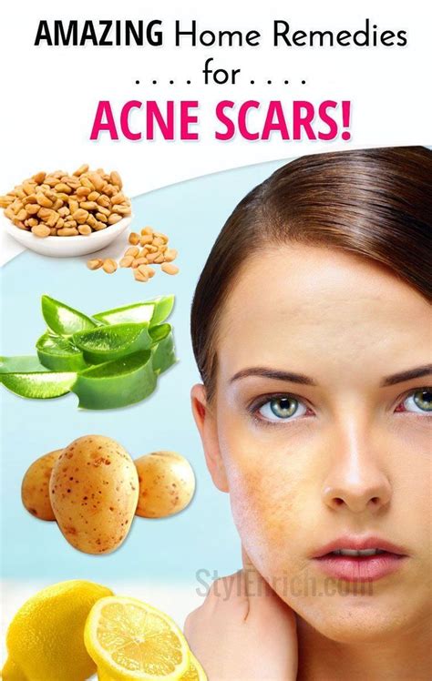 Pin On Skin Care Pimples Home Remedies