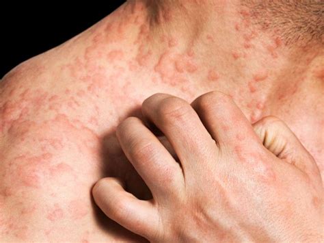 Skin Diseases Have Large Impact On Patients Well Being