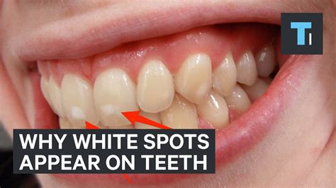 Heres Why Some People Have White Spots On Their Teeth Youtube