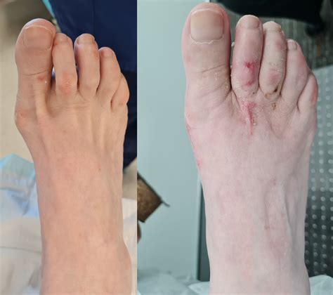 Hallux Valgus Foot And Podiatry Surgery