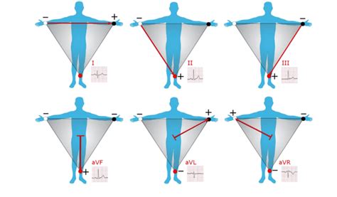 5 Leads Placement In Einthovians Triangle Download