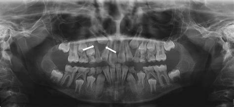 Jaw Lesions Associated With Impacted Tooth A Radiographic Diagnostic Guide