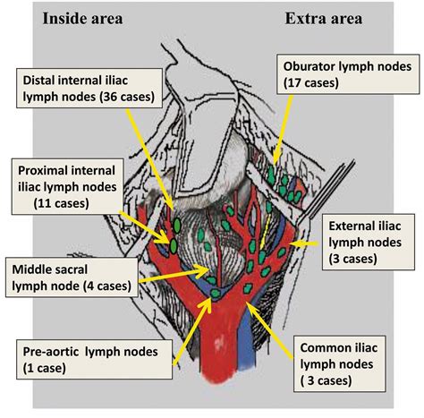 Cancer In Groin Lymph Nodes