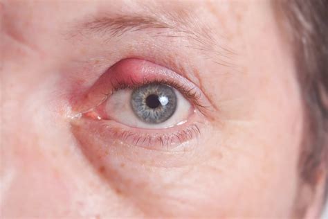 Hordeolum Styes Eye Health Library Bc Doctors Of Optometry