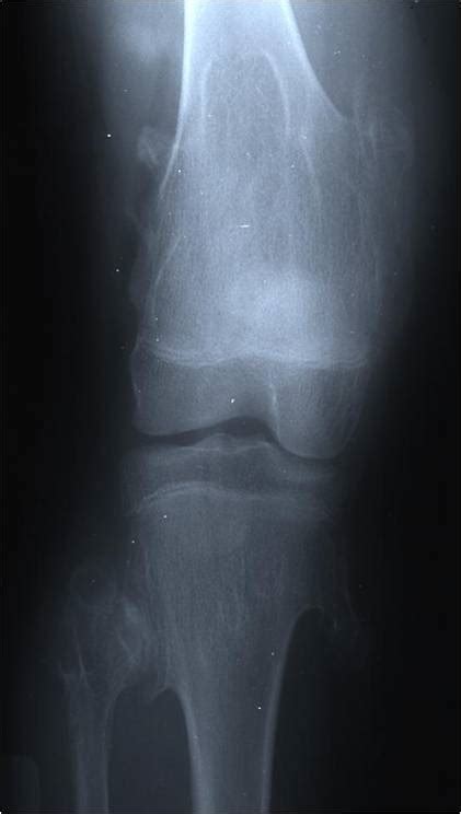 Osteochondroma Benign Bone Tumor Tumors Of The Bone