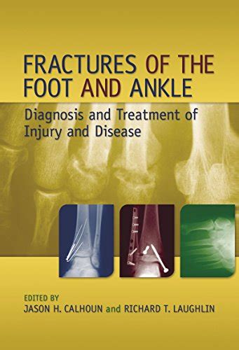 Fractures Of The Foot And Ankle Diagnosis And Treatment Of Injury And
