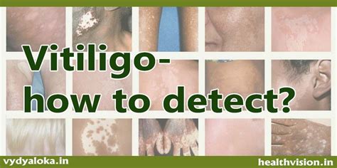 Vitiligo How To Detect And Signs People Should Look Out For Health