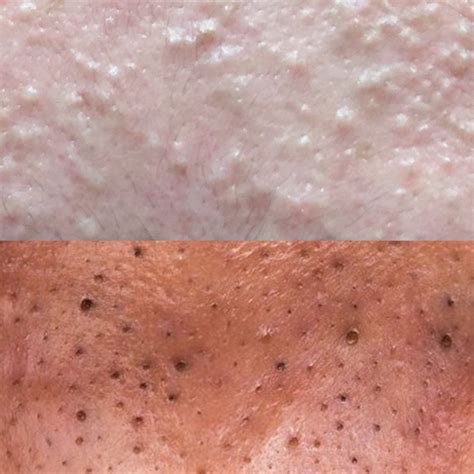 Blackheads Vs Whiteheads Slmd Skincare By Sandra Lee Md Dr