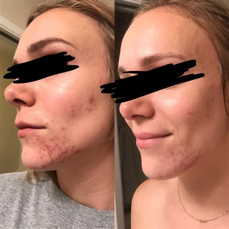 Hilariously, fungal acne isn't actually an acne condition. Before & After Finally healing my fungal acne ...