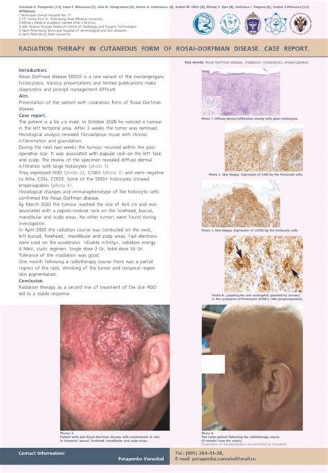 Pdf Radiation Therapy In Cutaneous Form Of Rosai Dorfman Disease