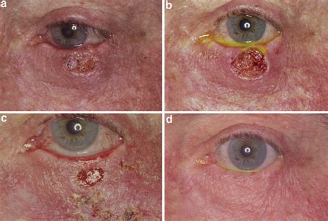 Treatment Of Basal Cell Carcinoma Of The Eyelids With 5 Topical