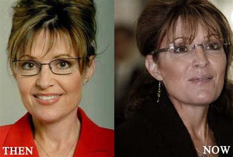 Bristol palin plastic surgery before and after photos. Sarah Palin Plastic Surgery Botox Injections Before and ...