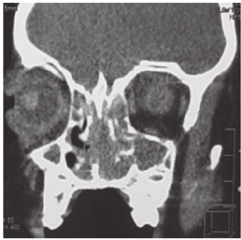 Paranasal Computed Tomography Scan Of Rhabdomyosarcoma Filling The