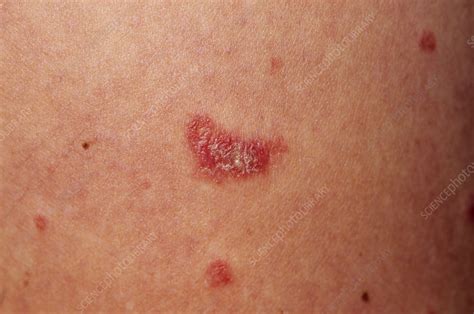 Guttate Psoriasis Stock Image M2400524 Science Photo Library