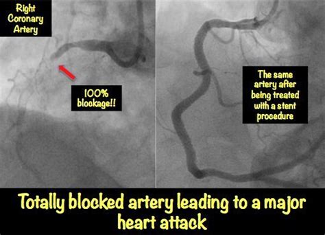 Heart Blockage Explained With Pictures Myheart