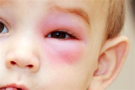 ¡cuidado Trauma Ocular Es Una Amenaza Para La Visión De Los Niños