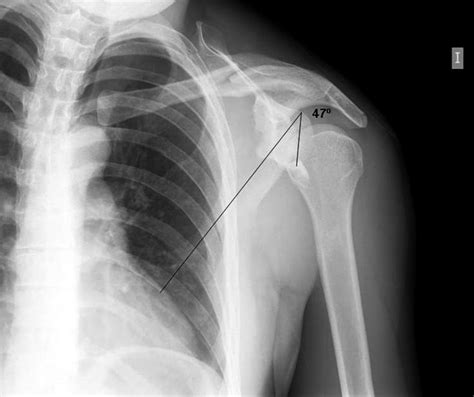 Radiografía anteroposterior de hombro fractura del tercio medio de la Download Scientific