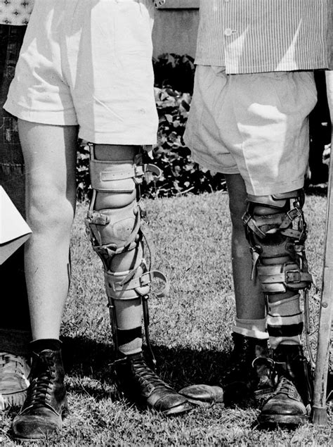 Polio Legs And Calipers Leg Braces Polio Legs