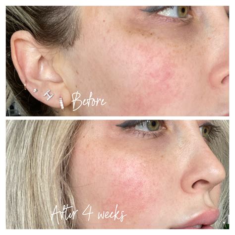 Musely Review The Dark Spot Cream That Actually Worked For Me Blondie In The City