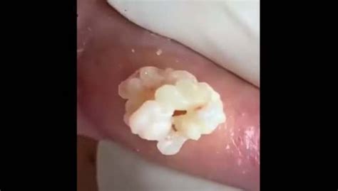sebaceous cyst with white pus drained new pimple popping videos