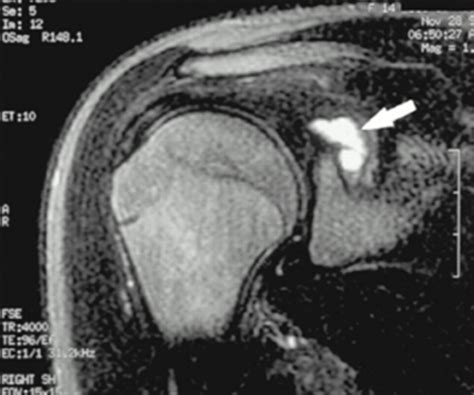 Suprascapular Neuropathy Shoulder And Elbow Orthobullets