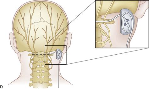 Complications Of Cranial Nerve Stimulation Anesthesia Key