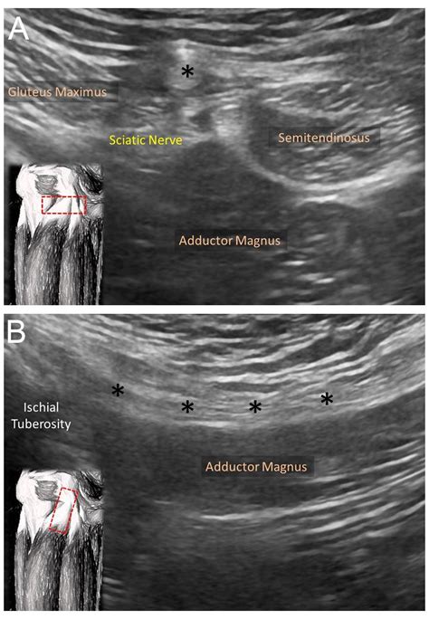 Biceps Tendon Rupture Of The Lower Limb Article
