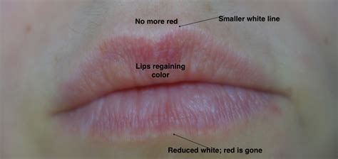 Whitish Discoloration Of Lips
