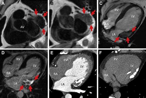 Caseous Mitral Annular Calcification At Cardiac Magnetic Resonance