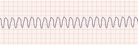 Rhythm Recognition Acls Medical Training