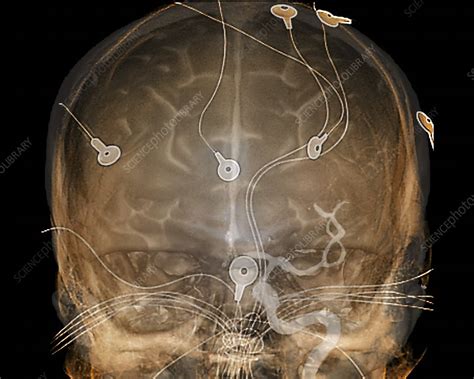 Electroencephalography Angiogram Stock Image C0211921 Science