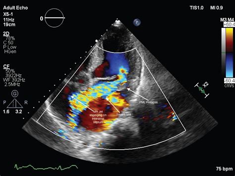 Mitral Valve Prolapse Echocardiography