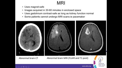 Ct Scan Detect Brain Tumor Mapametawan