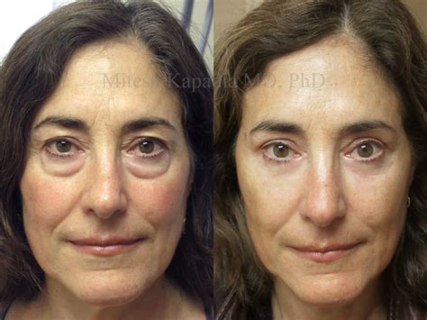 Upper And Lower Blepharoplasty Before And After Photos Boston Eyelids