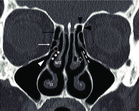 Coronal Ct Scan Showing The Components Of The Ostiomeatal Unit Ethmoid