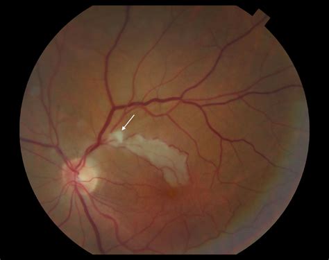 Central Retinal Artery Occlusion Vs Normal