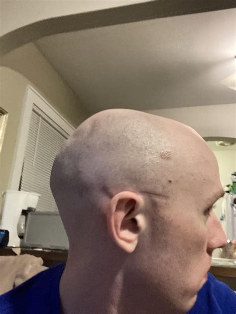 Shaved My Head And Noticed Some Dentslumps On My Skull Also My Entire