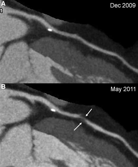 Repeat Coronary Computed Tomographic Angiography In Patients With A