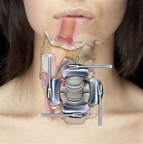 How Does Cervical Spine Surgery Potentially Cause Voice And Swallow