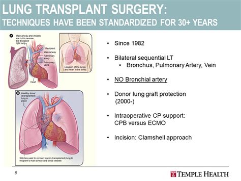 Lung Transplant Surgery Techniques Have Been Standardized For 30 Years Surgical Approach To