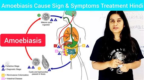 Amoebiasis Cause Symptoms Treatment In Hindi What Is Amoebiasis In