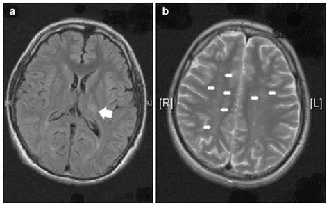 Mri Imaging Of The Brain Showed Acute Left Posterior Thalamic Infarct