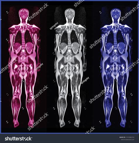 Whole Body Mri Scan Normal Human Stok Fotoğrafı 1310382316 Shutterstock