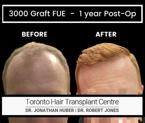 Hair Transplant Results Toronto Hair Transplant Surgeons