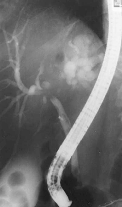 The Biliary Tree And Pancreas Radiology Key