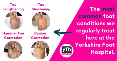 the most common foot conditions yorkshire foot hospital