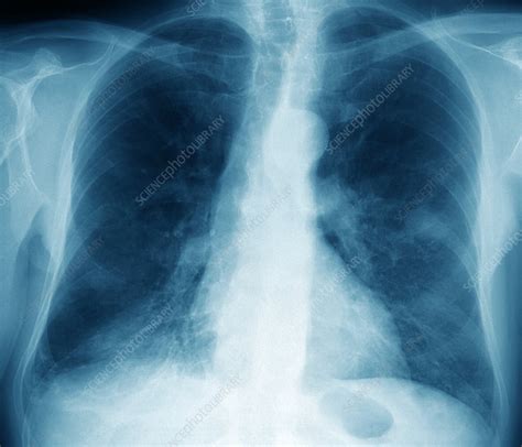 Lung Cancer X Ray Stock Image M1340753 Science Photo Library